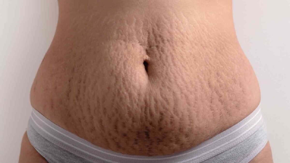 5 Natural Oils To Reduce Stretch Marks