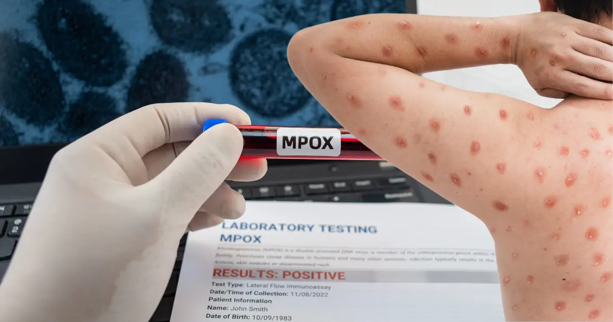 Protect Yourself from Mpox Essential Prevention Tips